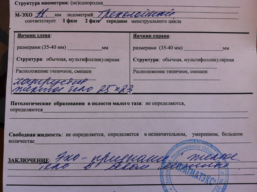 Плод в левом яичнике Плод в левом яичнике