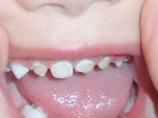 портятся зубки