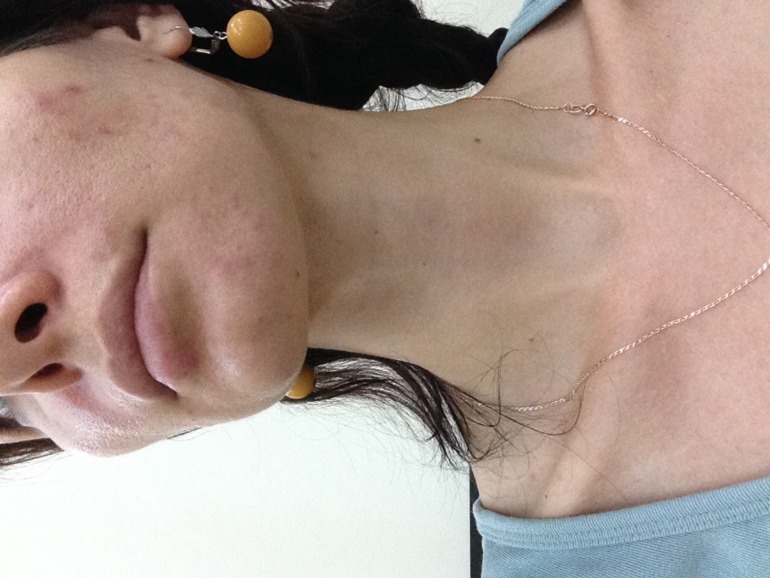 Мой отчет iPL лазер. Борюсь с прыщами! -1