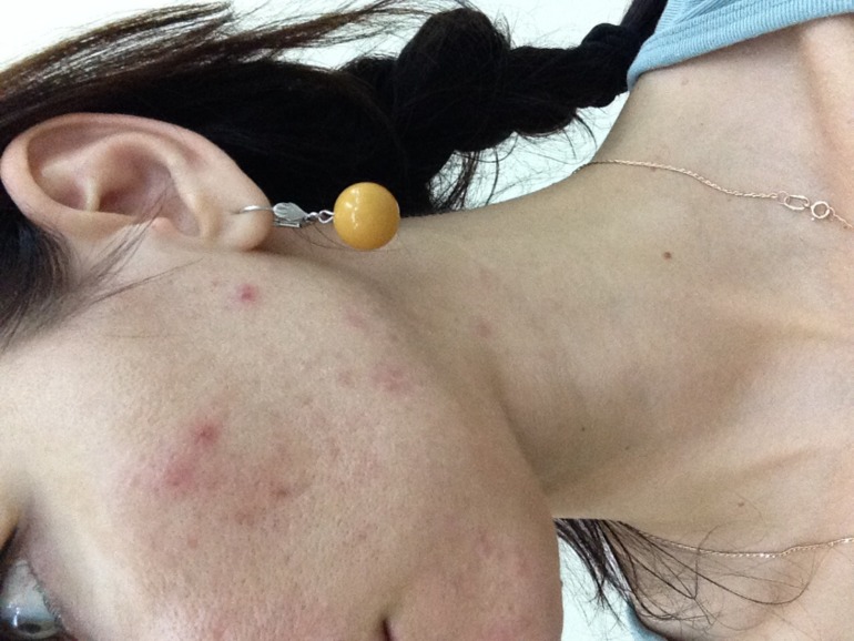 Мой отчет iPL лазер. Борюсь с прыщами! -1