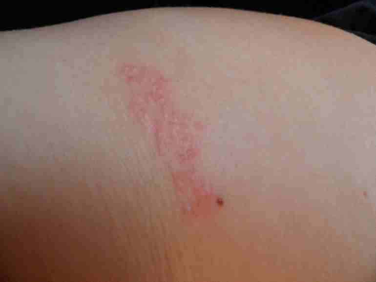 Вроде аллергия, раньше не было ничего подобного