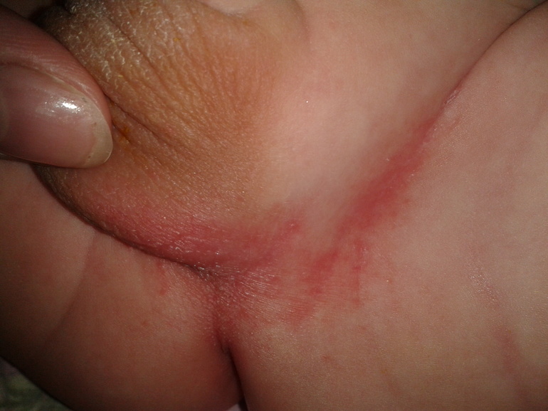 Аллергия????