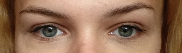 у меня нависающее веко?