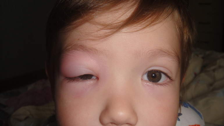 что с глазиком?