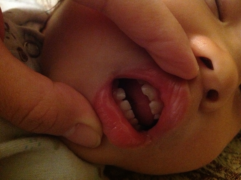 Помогите подалуйста!Скол, травма или кариес?????