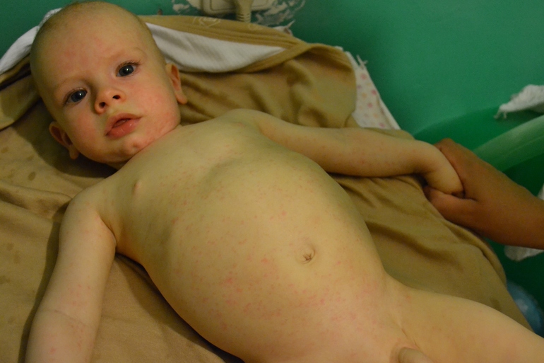 Высокая температура и больше ничего