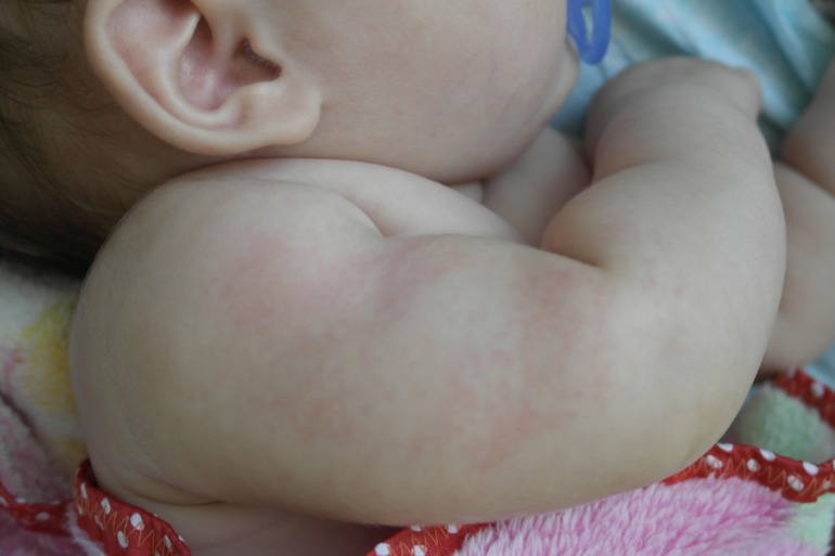 Травмы от намотки?