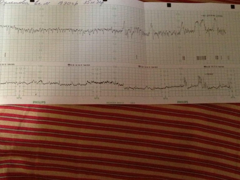 Девочки!!Помогите расшифровать КТГ,пожалуйста!