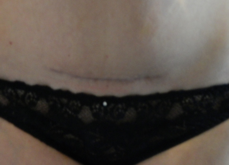 Шрам от кесарева...станет ли он другим?