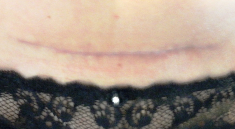 Шрам от кесарева...станет ли он другим?