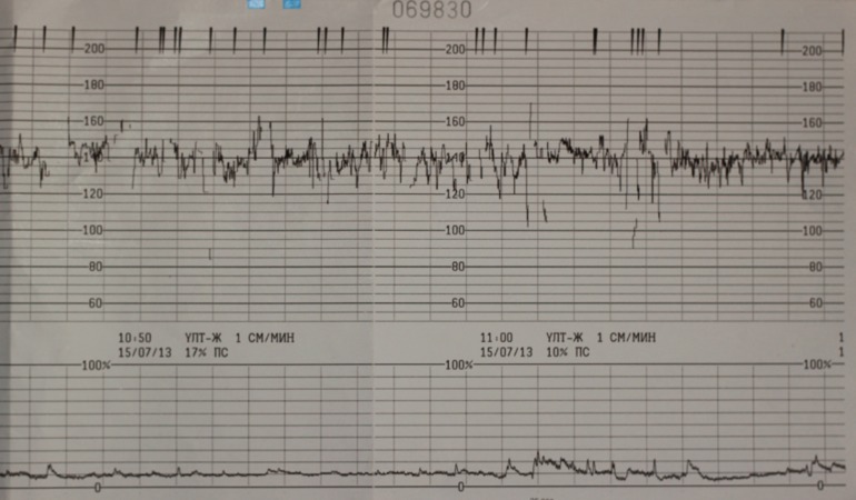 Фото ктг беременной