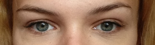у меня нависающее веко?