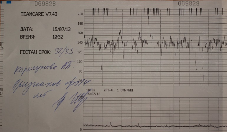 Фото ктг при родах