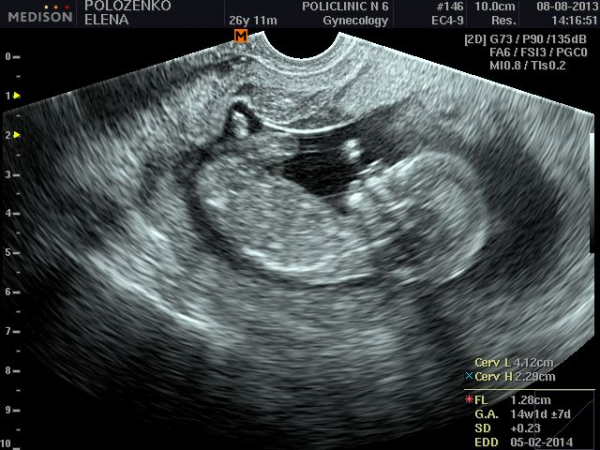 Снимки УЗИ на 13 неделе беременности. УЗИ 12-13 недель беременности. Как выглядит ребенок на УЗИ В 13 недель. Сколько будет 13 недель