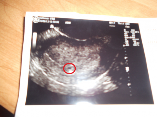 2 х недель месяца. УЗИ 2 недели беременности. УЗИ 2 недели беременности фото. УЗИ 2 недели от зачатия. УЗИ 1.5 недели беременности.