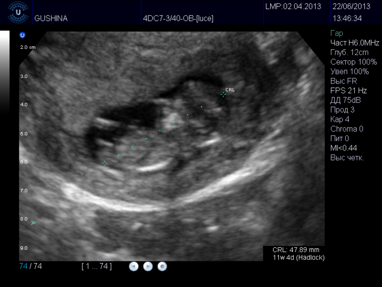 Узи 13 недель определить пол. Пол ребенка на УЗИ. Пол на УЗИ. УЗИ мальчик или девочки. УЗИ определение пола.