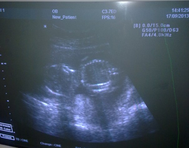 Поход на узи