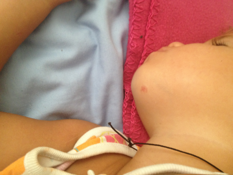 Гемангиома, наш опыт