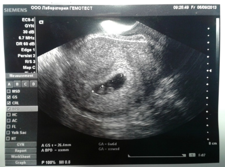 Тонус матки первый триместр. УЗИ 6 недель беременности гипертонус. Беременность двойней УЗИ на ранних сроках беременности. УЗИ 4 недели беременности Близнецы. УЗИ 5-6 недель беременности на ранних сроках.