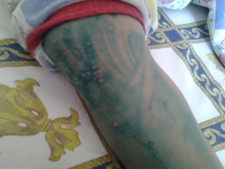 ветрянка день 2