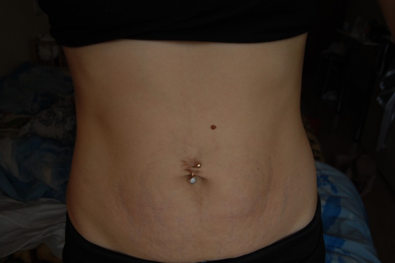 Борьба с растяжками. Прошло 6 месяцов после начала..