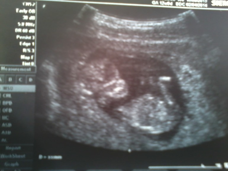 12 недель и 3 дня. Как выглядит ребёнок в 12 недель. Как выглядит ребёнок в 12нидель. УЗИ В 12 недель беременности форум.