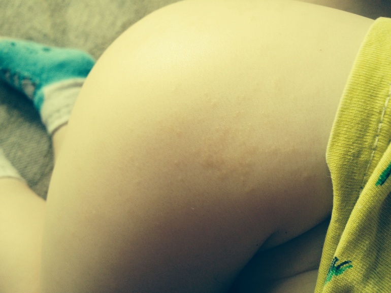 Это аллергия